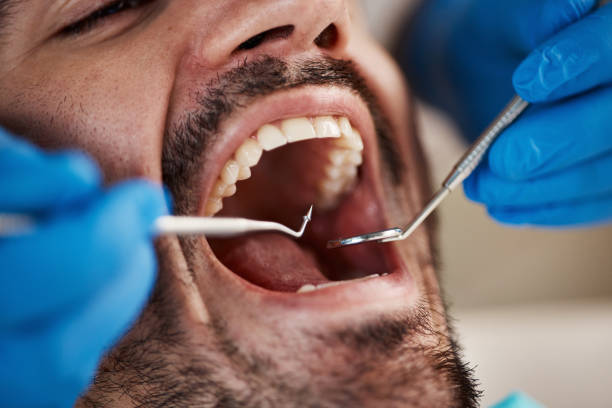 Best Emergency Dentist for Knocked-Out Tooth in Cypress Gardens, FL
